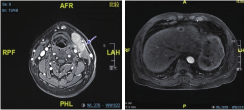 图2（2） 喉MRI及腹部MRI（2疗程后）.jpg